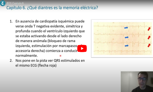 🎥❤️ Vídeopíldora: ¿Qué diantres es la memoria eléctrica? ➡️➡️ cardioteca.com/videos/video-c… 💥Trucos y consejos para hacer la electrocardiografía más fácil con @HiguerasJavier #ecg #cardiologia #cardiotwitter @ESTEVE_ESP