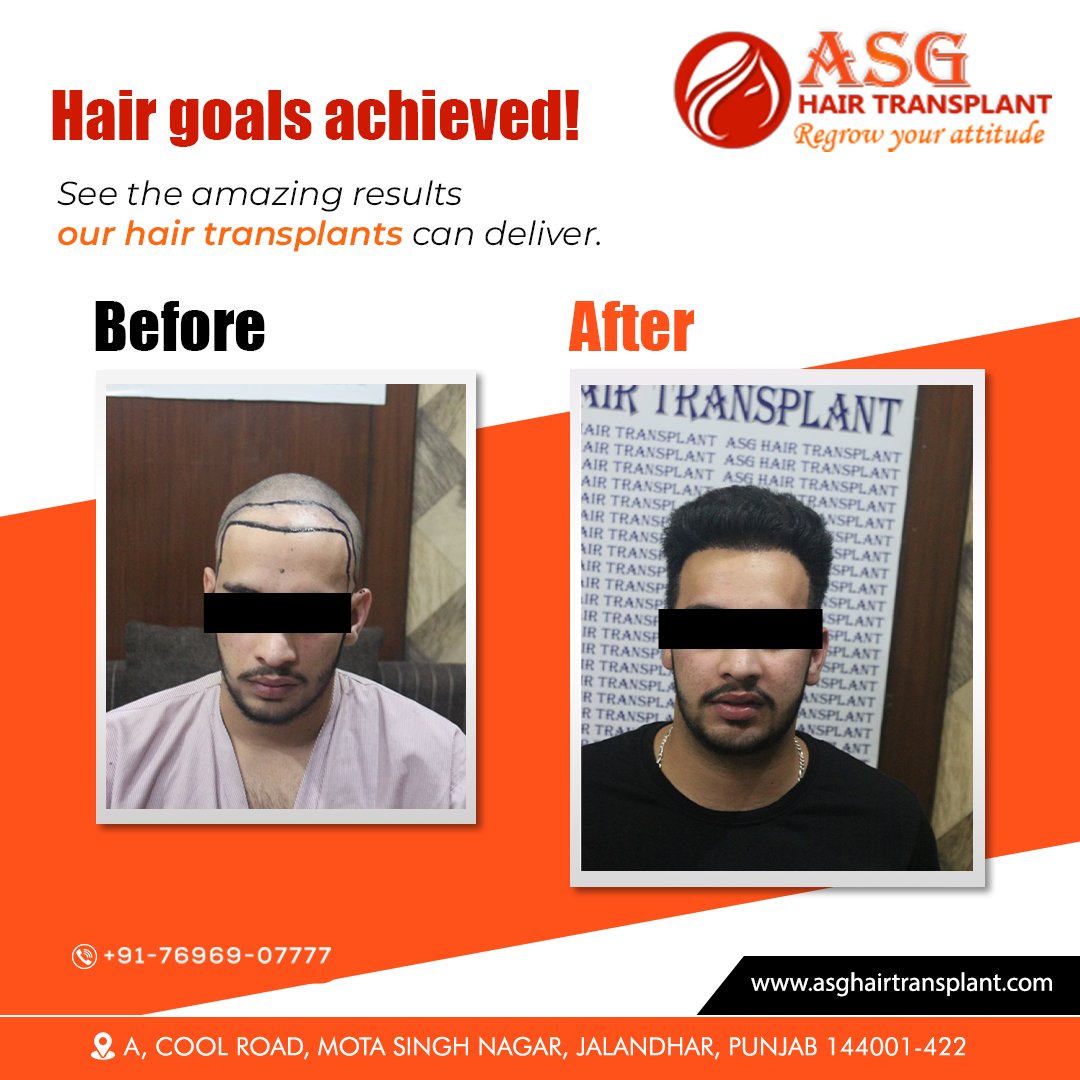 Hair goals achieved! Witness the remarkable transformations our hair transplants can accomplish. 

☎️ +91-76969-07777
🌐asghairtransplant.com

#HairGoals #HairTransplants #ConfidenceBoost #HairRestoration 
#HairLossTreatment #hairtransplantation #jalandhar #punjab #asg