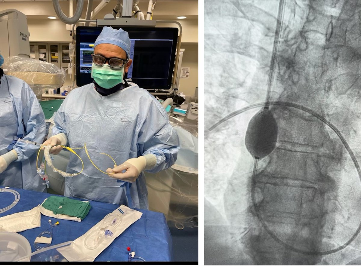 Excited to report that @ShashankDesai08 performed the first @ISHVnews implant of the preCARDIA balloon occlusion device to intermittently occlude the SVC, as part of VENUS HF, investigating feasibility/safety of this therapy for diuretic resistant, acute heart failure.