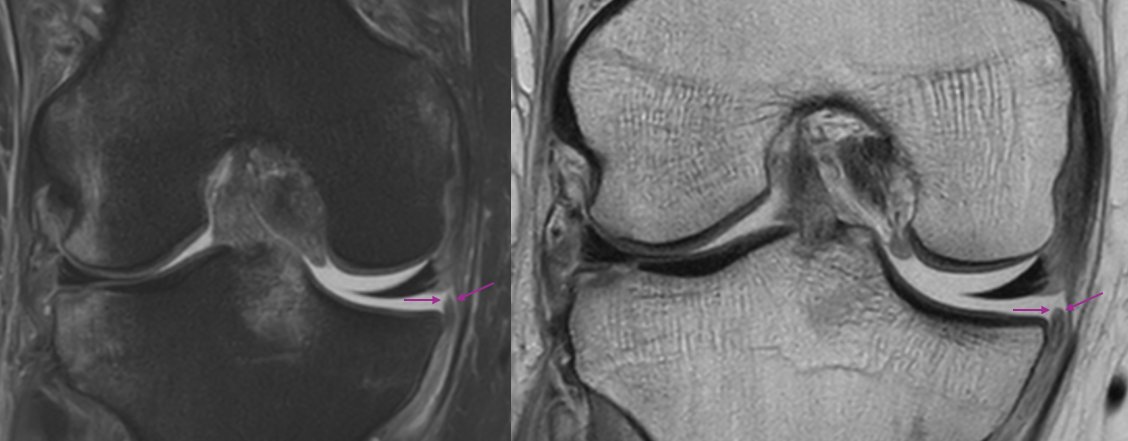 31 y/o Male. Motorcycle accident. Acute meniscotibial ligament rupture