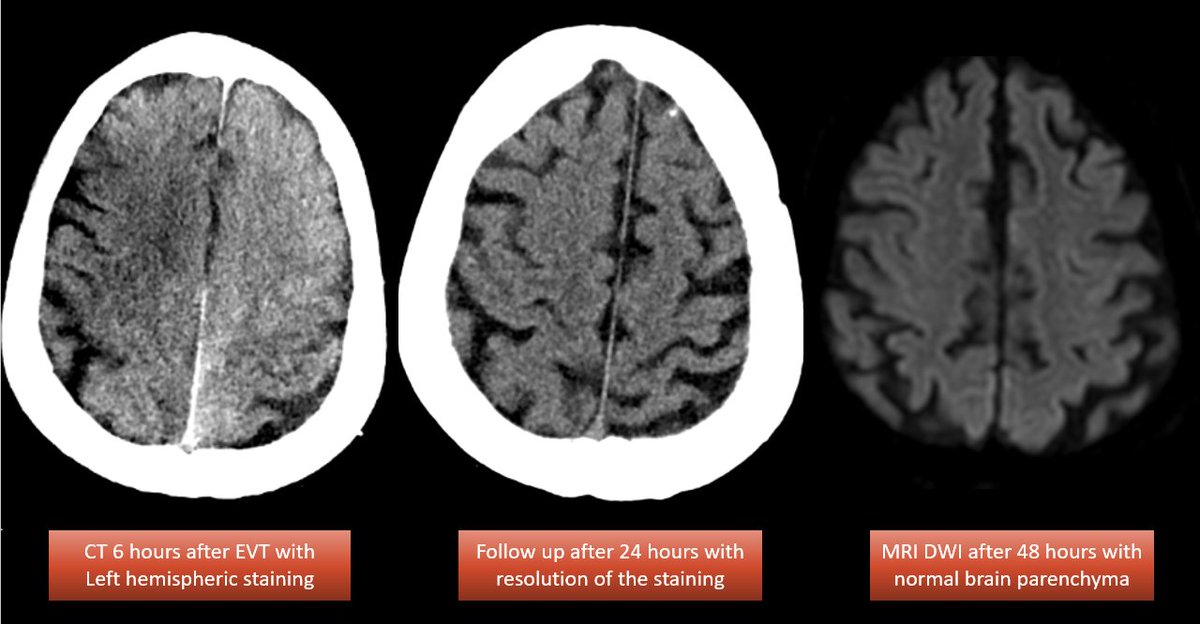 Mohamad AbdalKader (@abdalkadermd) on Twitter photo Contrast staining after endovascular treatment for acute ischemic stroke isn't always indicative of infarcted tissue. It may occur in ischemic areas, likely due to reversible disruption of the blood-brain barrier
<a href="/AnuragSahoo91/">Anurag Sahoo</a> <a href="/PiersKlein/">Piers Klein</a> <a href="/NguyenThanhMD/">Thanh Nguyen 🇺🇦</a>
ajnr.org/content/early/… Contrast staining after endovascular treatment for acute ischemic stroke isn't always indicative of infarcted tissue. It may occur in ischemic areas, likely due to reversible disruption of the blood-brain barrier
<a href="/AnuragSahoo91/">Anurag Sahoo</a> <a href="/PiersKlein/">Piers Klein</a> <a href="/NguyenThanhMD/">Thanh Nguyen 🇺🇦</a>
ajnr.org/content/early/…