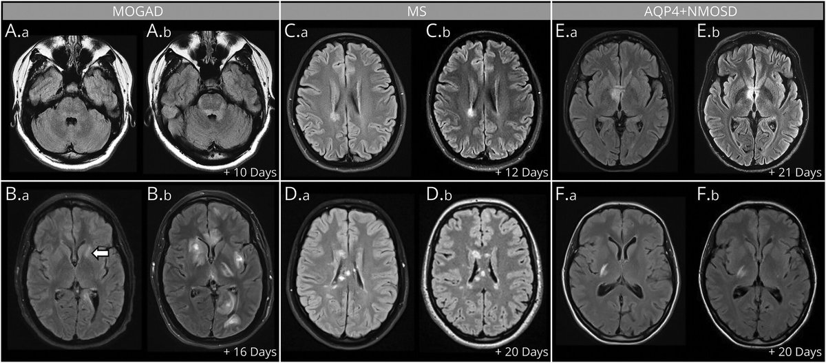 Happy to share @Lauz_Caccia et al study of #MOGAD lesion changes during attacks: ➡️ 10% of attacks have an initial normal MRI (radiologic lag) ➡️ MRI more dynamic than in #MS or #NMOSD with T2-Lesions often appearing & sometimes resolving within attacks👇neurology.org/doi/10.1212/WN…