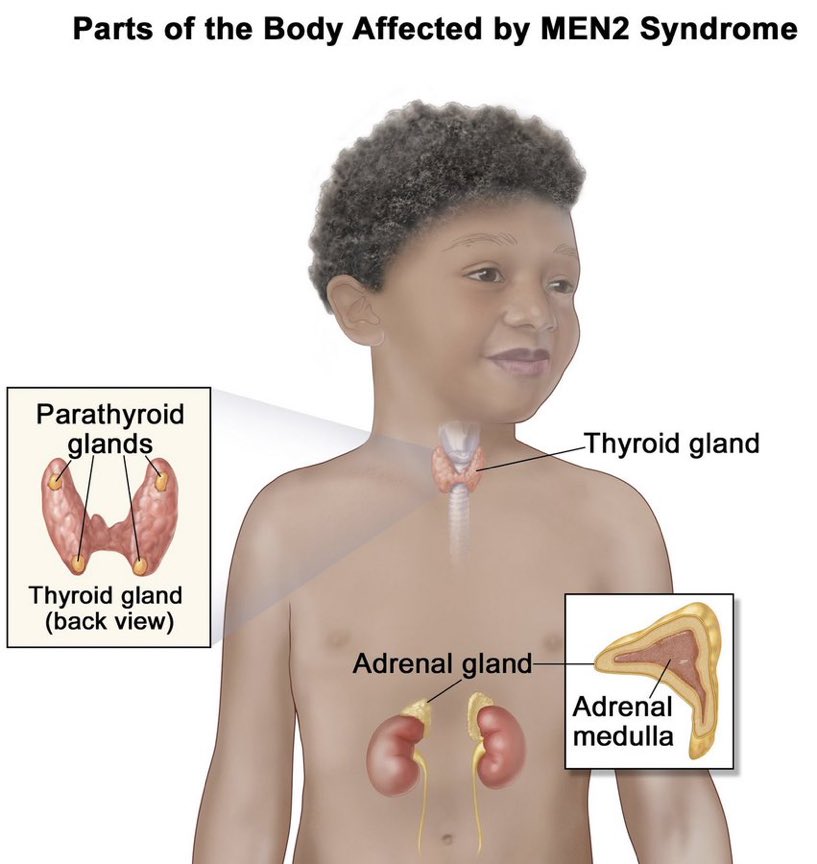 Pheochromocytoma associated w/ MEN 2 - rare, genetic, endocrine gland tumors in thyroid gland, parathyroid glands & adrenal glands; Cause: RET mutation; 3 subtypes (MEN2A, MEN2B, FMTC); MEN2: medullary thyroid cancer,  pheochromocytoma, parathyroid gland cancer