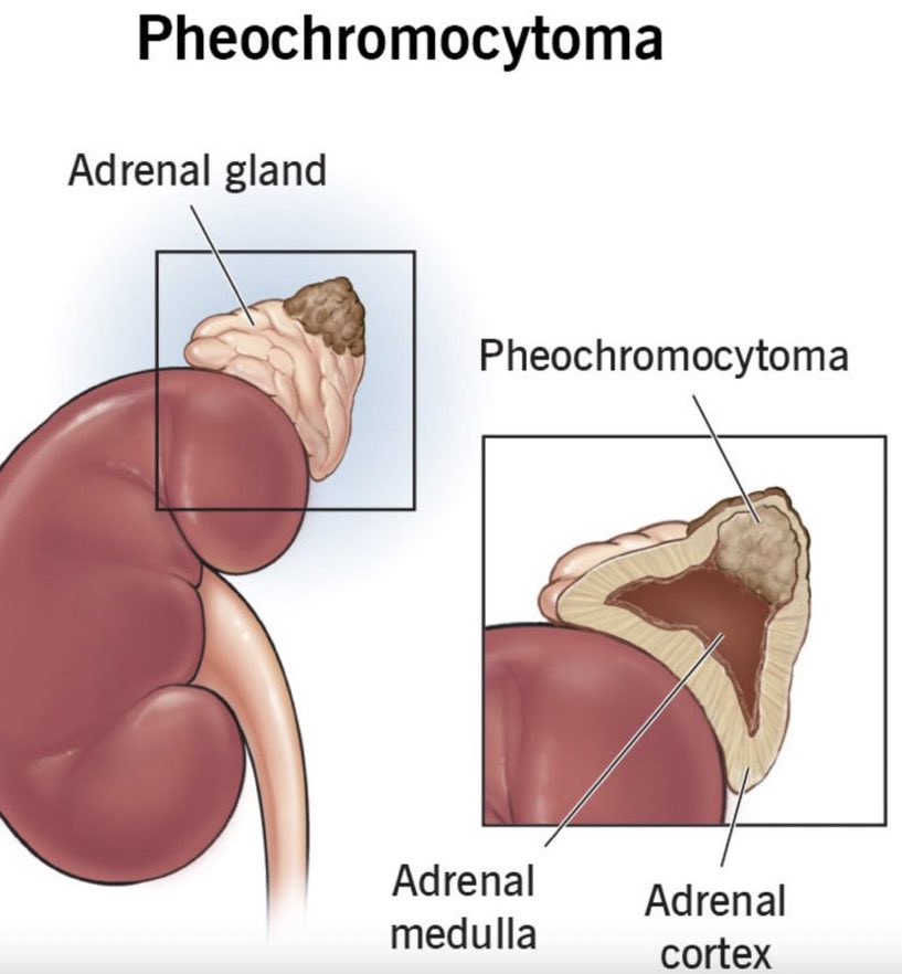 Pheochromocytoma - Adrenal catecholamine-secreting tumor;
s/s: HA,  sweating,  palpitations, tremors, vision chgs;
PE: HTN, orthostasis; 
Dx: ↑24h urinary catecholamines & metanephrines, or ↑plasma metanephrines, CT or MRI; 
Rx: alpha-blocker prior to beta-blockade ->resection