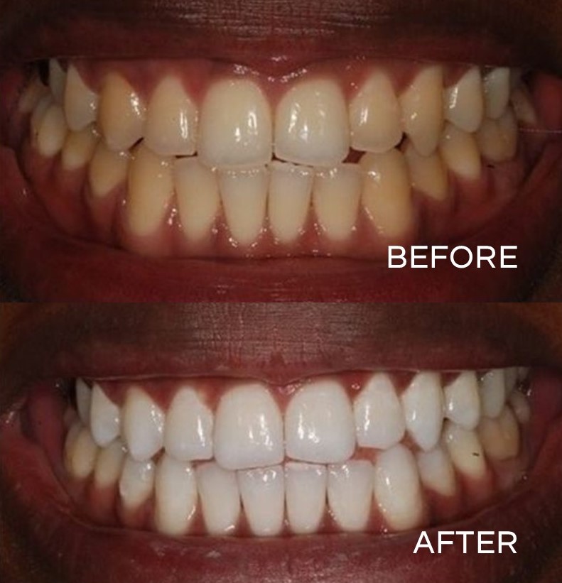 The before photo is of a patient with slight discolouration to her teeth. The after photo is the result of dental cleaning procedure.

#flossdental #thetoothdr #flossboss #beforeandafter #dentalwhitening #repost #philips #oralhealth #dentist #dentistry #trinidadandtobago