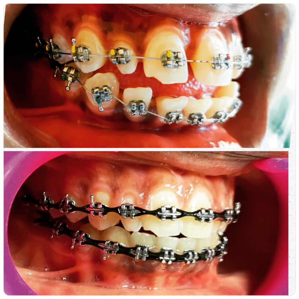 Braces are able to fully close gaps in a safe, effective and long-lasting manner💪🏽.

Start your amazing journey with us today✨

📍Nairobi CBD, Pension Towers, Loita Street, 2nd Floor. Open Mon-Sat 7am to 7pm. Open every Sunday 8:30am to 7pm.