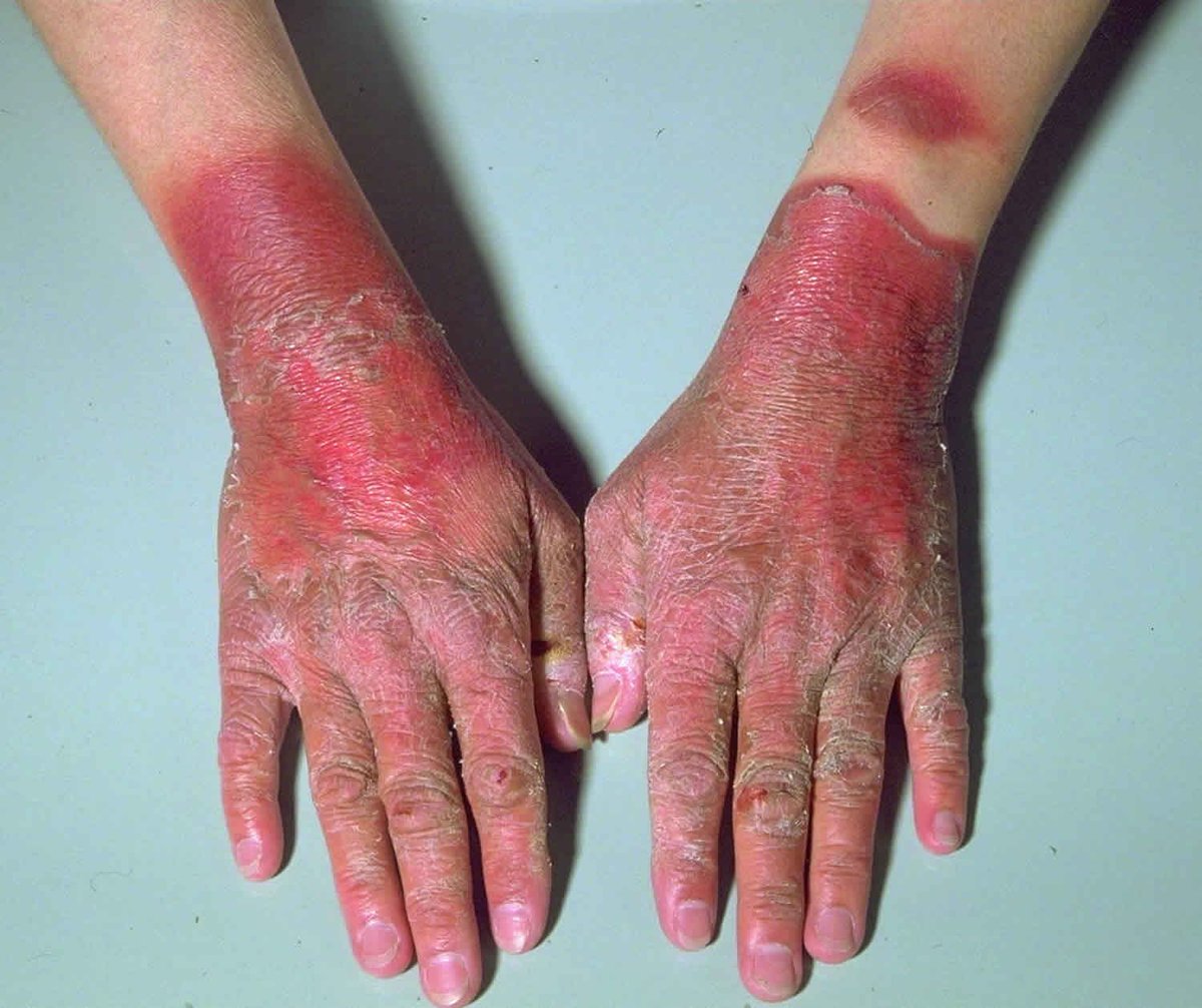 #MedEd #USMLE #usmle #ecfmg #MedTwitter 

A 15 y.o male presented with 
Photosensitive dermatitis 
Intermittent ataxia
Unsteady gait 
Bluish discoloration in urine since childhood 
Dx ??