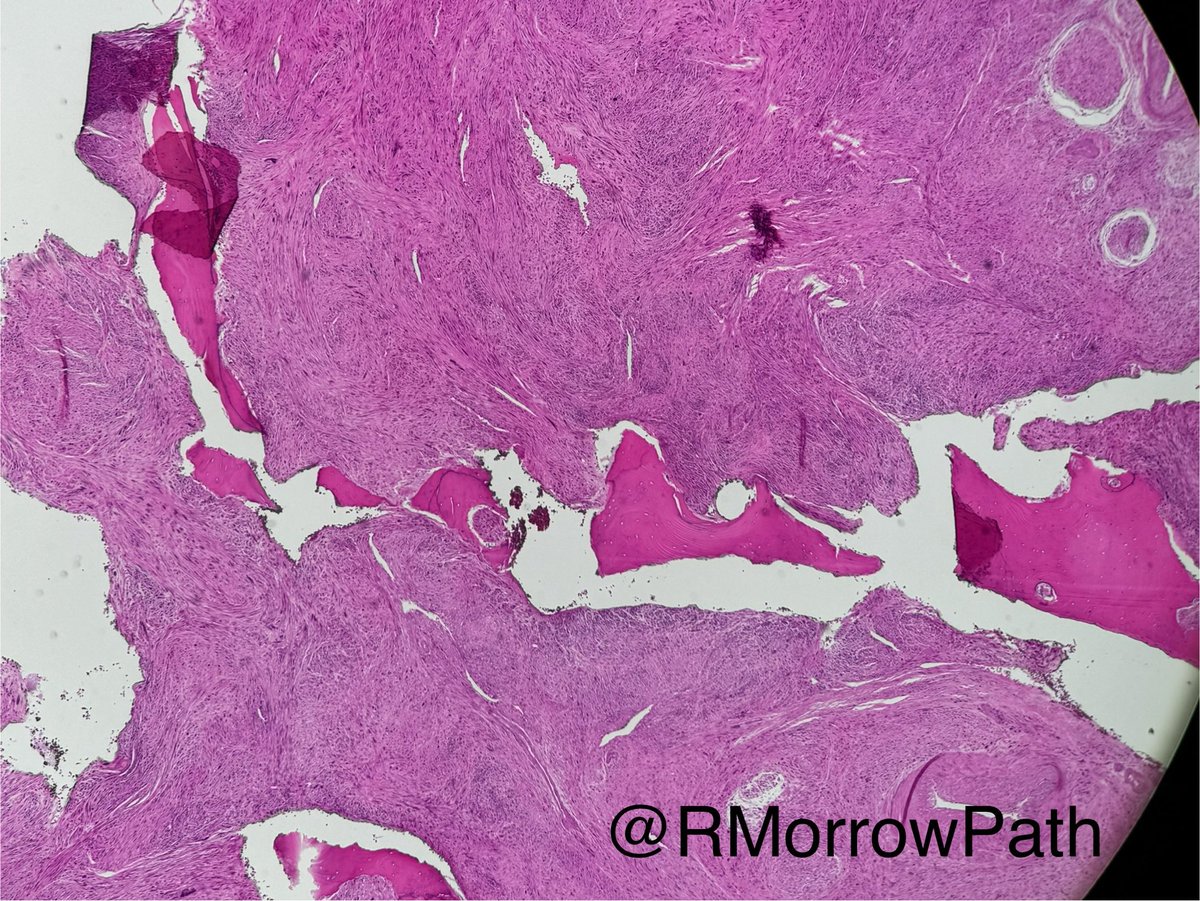 Nasal tumour… thoughts? #entpath #pathtwitter