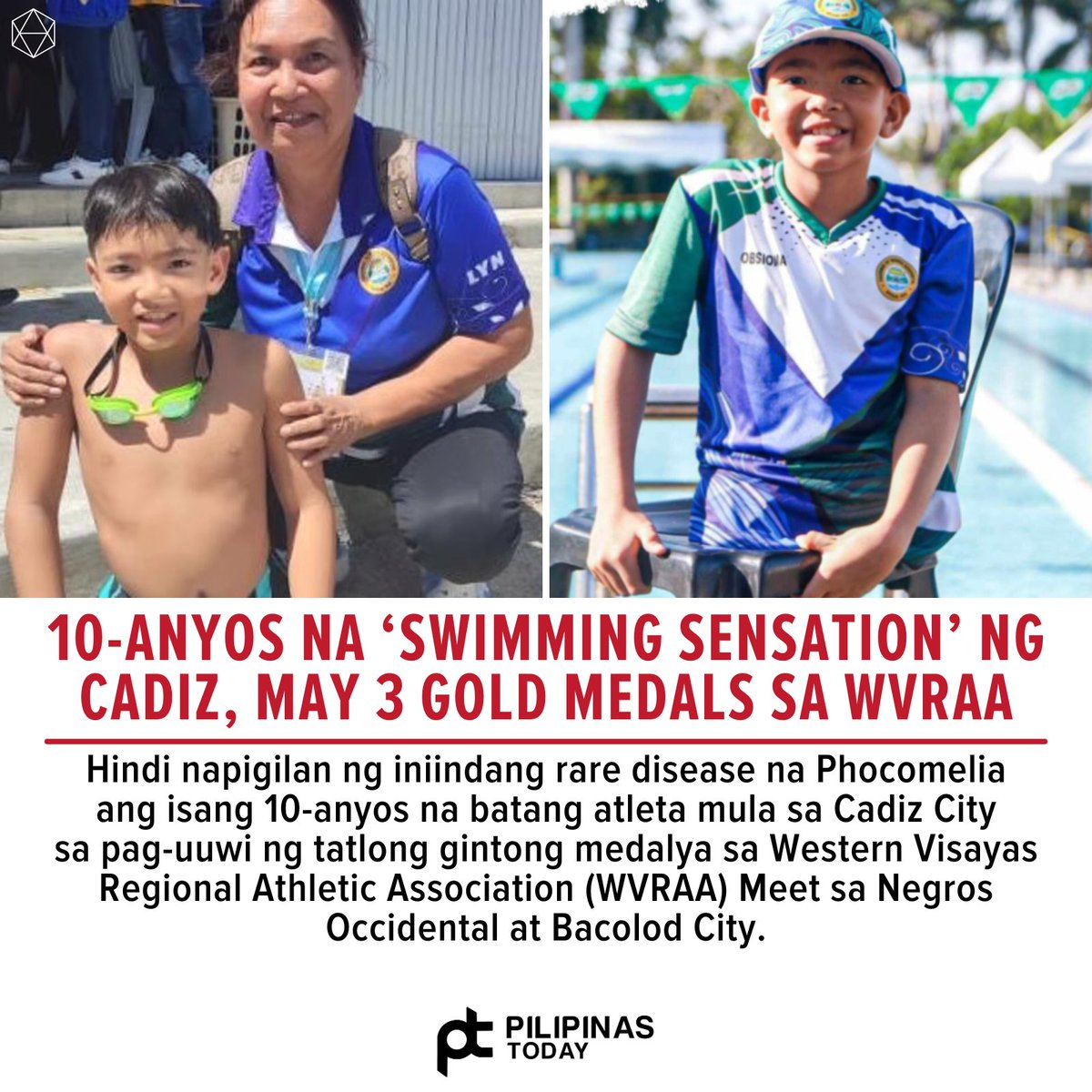 Sa kabila ng kanyang kondisyon, na nakakaapekto sa kanyang mga paa at kamay, humakot si Zach Lucas Obsioma ng tatlong gintong medalya sa mga swimming events ng paragames ng WVRAA.

Ang Phocomelia syndrome ay isang rare congenital anomaly na nailalarawan sa kawalan ng proximal na…