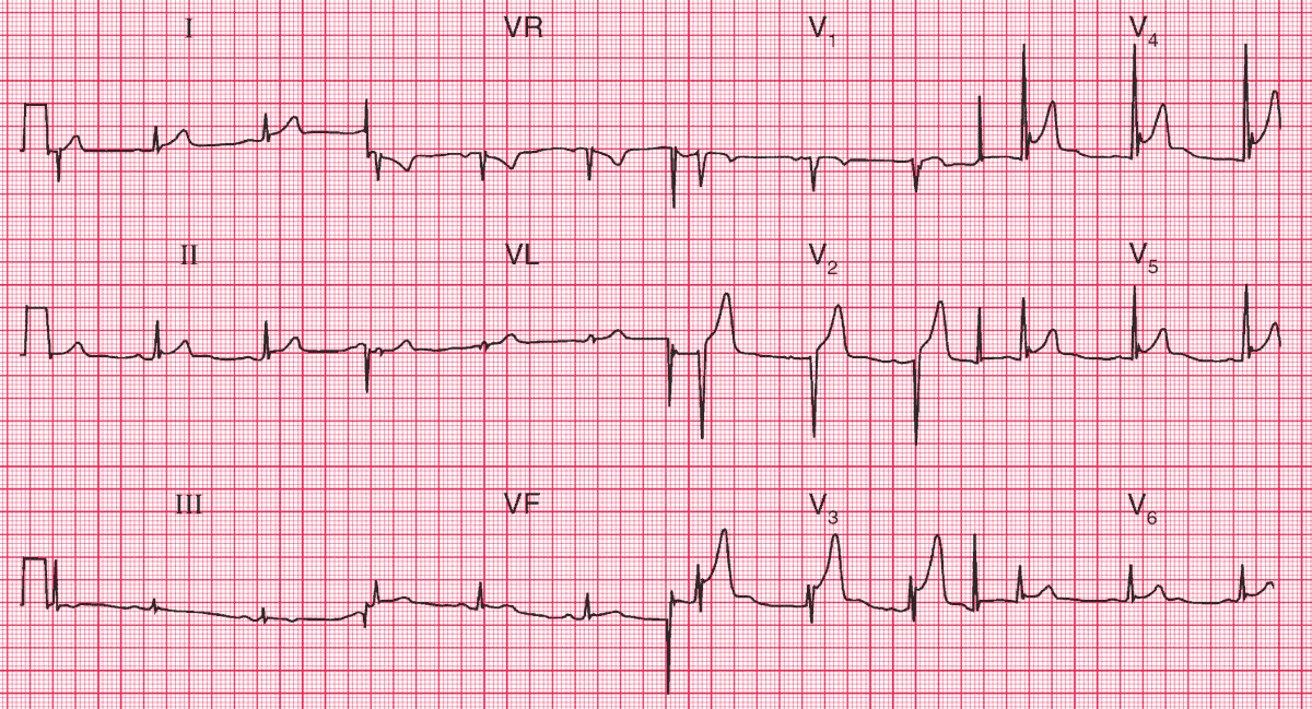 A 30-year-old man is seen in the ED with left-sided chest pain. 
- Is this MI or not?  

➡️ Interpretation and Answer: manualofmedicine.com/ecgs/ecg-case-…

#medtwitter #foamed #Cardiology #cardiotwitter