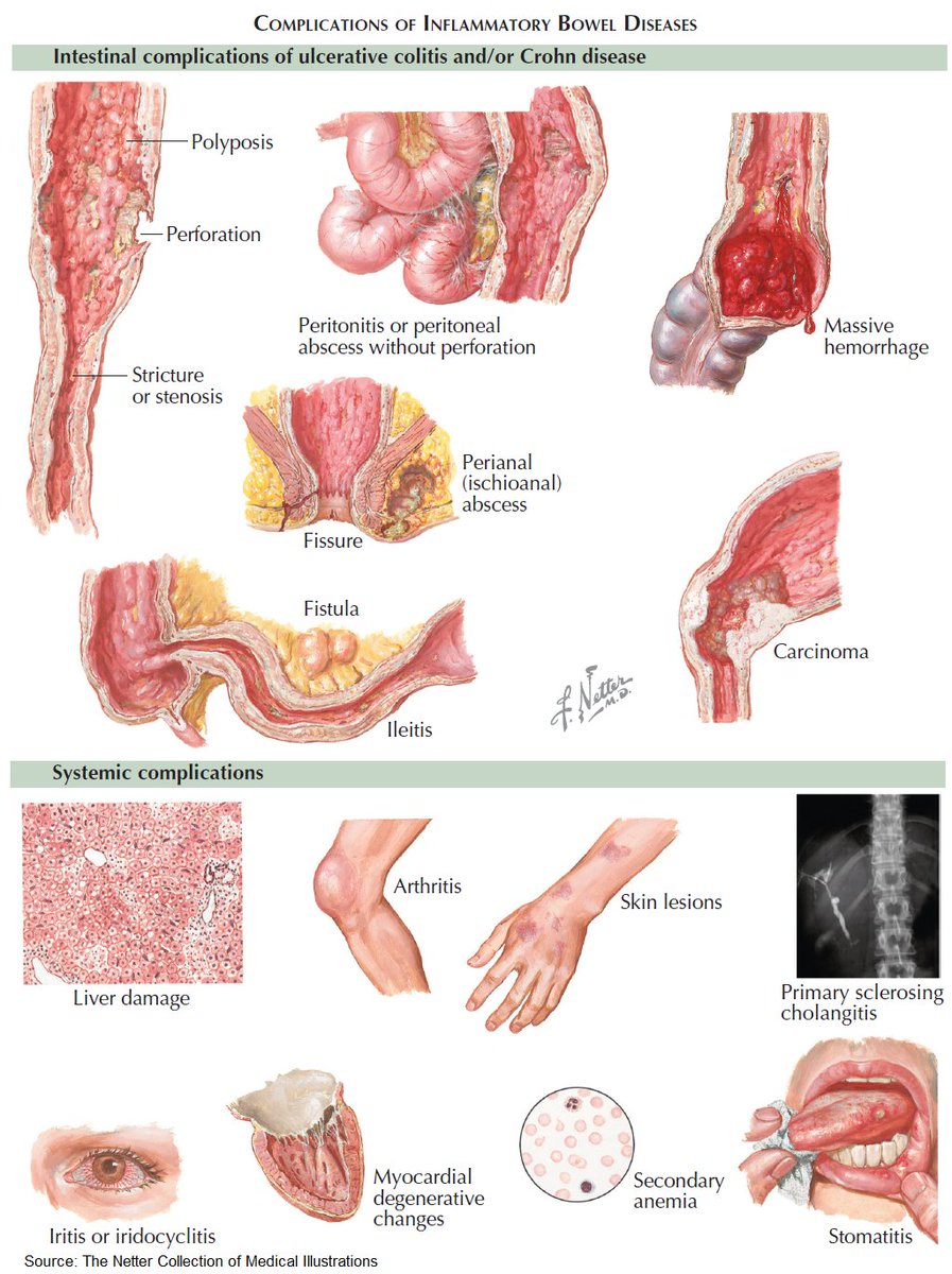 Complications of Inflammatory Bowel Diseases (Crohn and Ulcerative Colitis)

#medtwitter #foamed #meded