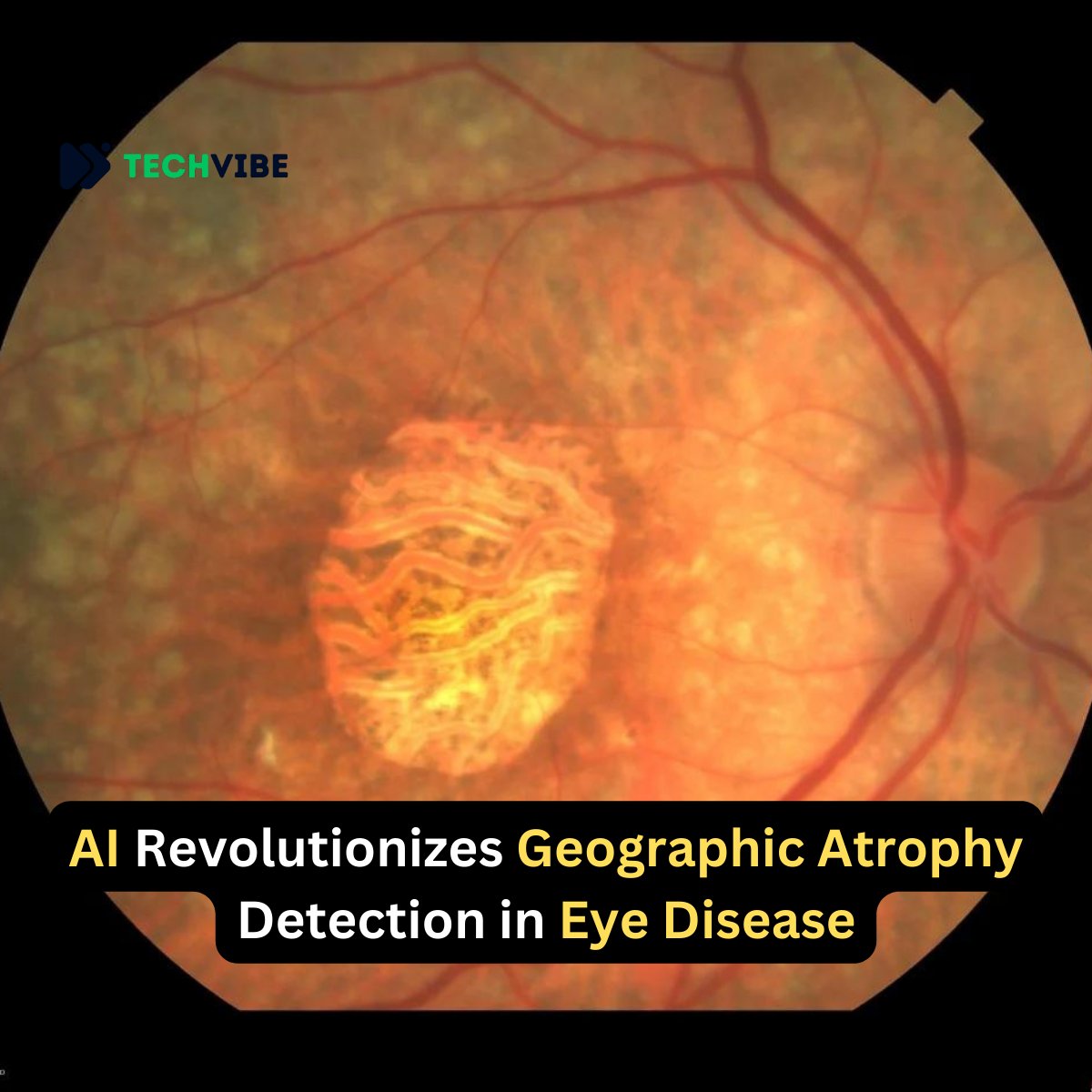 Cutting-edge AI technology revolutionizes the detection of geographic atrophy, a crucial aspect in managing eye diseases, offering a promising tool for more accurate diagnosis and treatment. more: t.ly/w9jer #geographicatrophy #Eye #AI #AInews