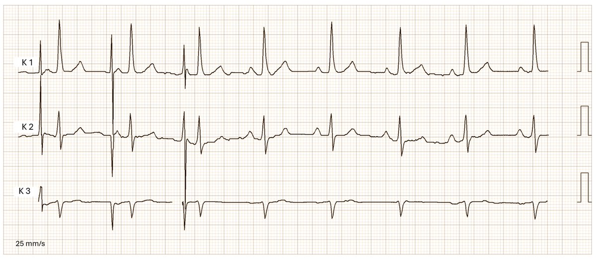 AAI pacing; Holter-strip; everything o.k.?