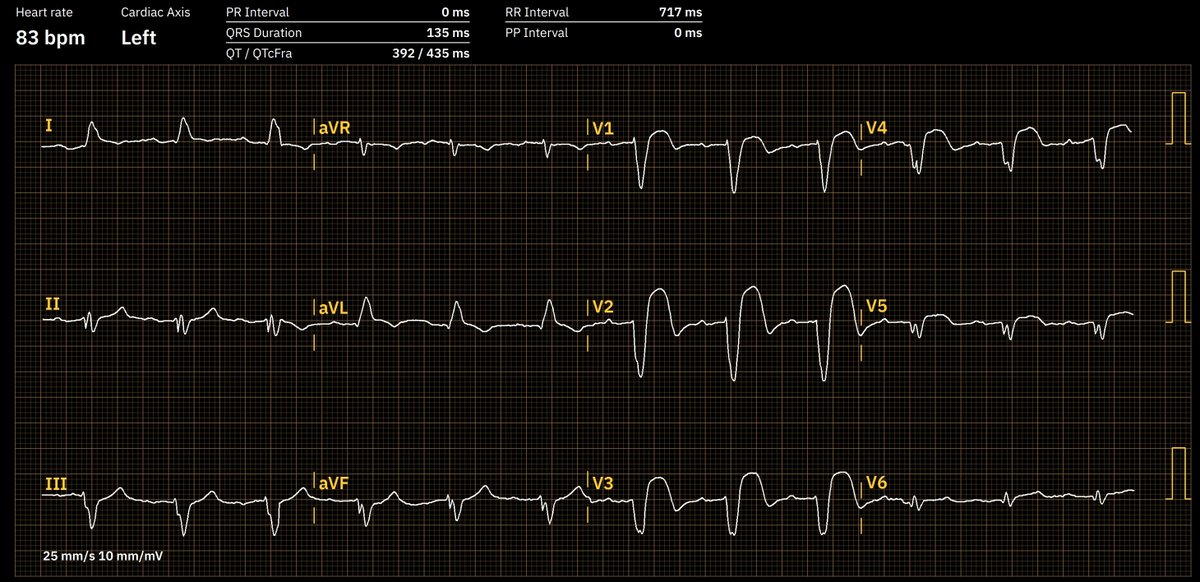 68 yo f, known CAD; chest pain for 30 minutes; what`s your take?