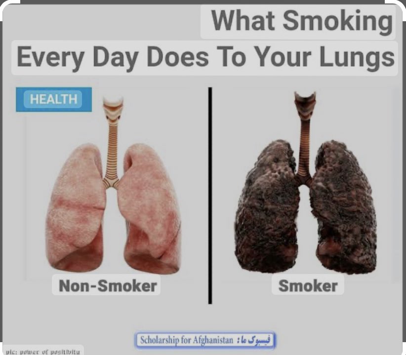 Lung diseases caused by smoking include COPD, which includes emphysema and chronic bronchitis. Cigarette smoking causes most cases of lung cancer. Check thread 👇