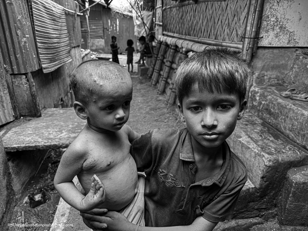 The affects of bad weather in Cox’s Bazar refugee camp. There are many children children in refugee camps that are facing the challenges of heatwave and can’t cope with weather. High fever ,rashes ,red rashes etc. including pain in whole body. #blackwhitephotography #rohingya