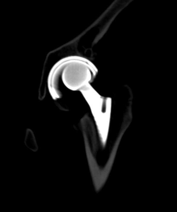 themskarchive's tweet photo. 7/5/2024. 🔴 A rare complication of hip arthroplasty: poliethilene wear posterior dislocation after closed reduction. #orthotwitter #traumatwitter #msk #hip https://t.co/8FXVC13AFK