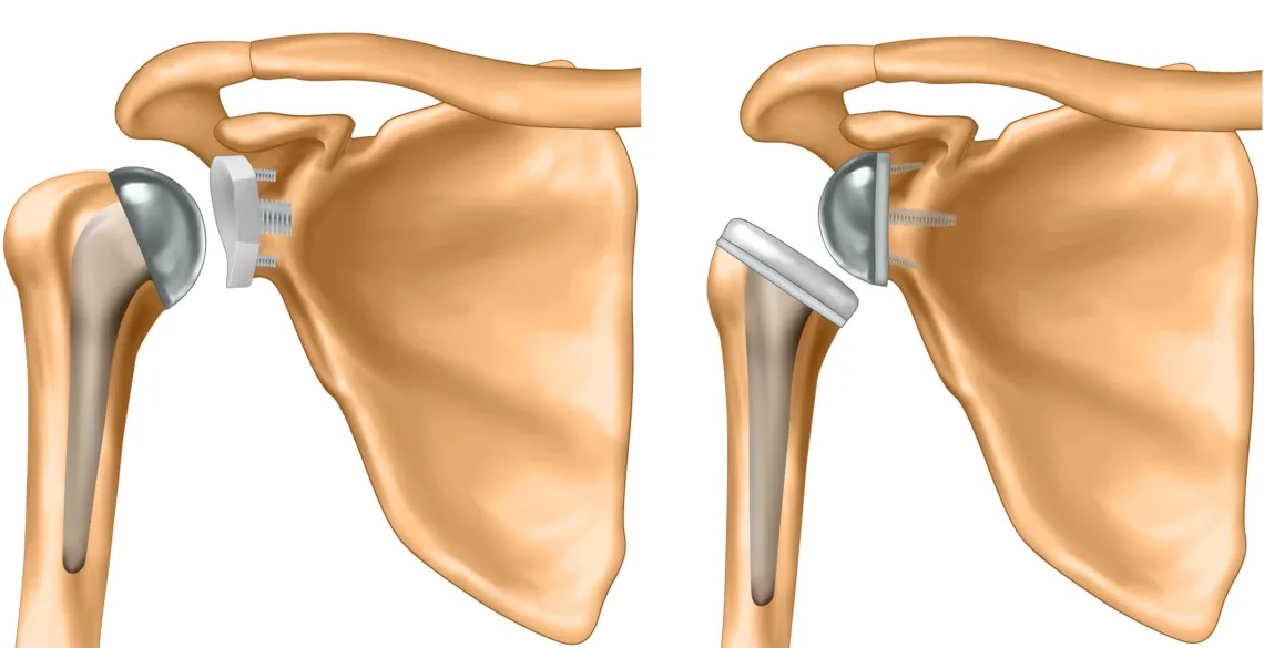 Did you see this? @MarkosValsamis looks at which type of shoulder replacement (reverse shoulder replacement or anatomical total shoulder replacement) is more beneficial in a new study. bmj.com/content/385/bm…