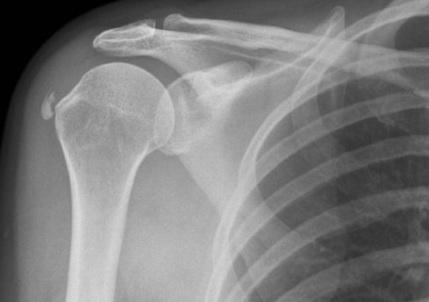 Polite request: please can Radiographers/ Radiologists stop reporting x rays like this as 'calcific tendinitis' ? Calcifications are often coincidental and not the cause of a presenting shoulder complaint