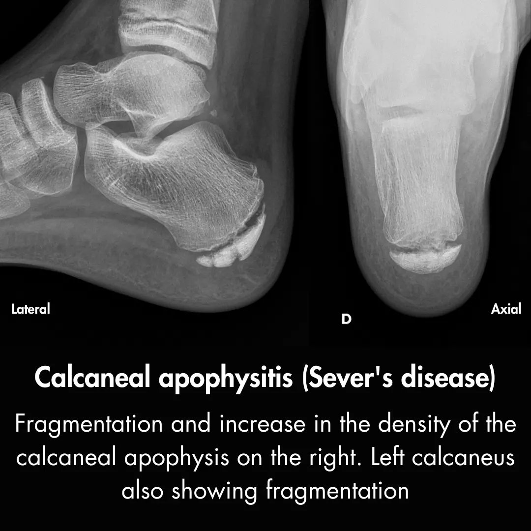 Calcaneal apophysitis, also known as Sever´s disease, is the primary cause of heel pain in pediatric patients between the ages of 8 and 15 years. Primary risk factors in pediatric athletes are obesity and high levels of physical activity. 

Case : radiopaedia.org/cases/calcanea…