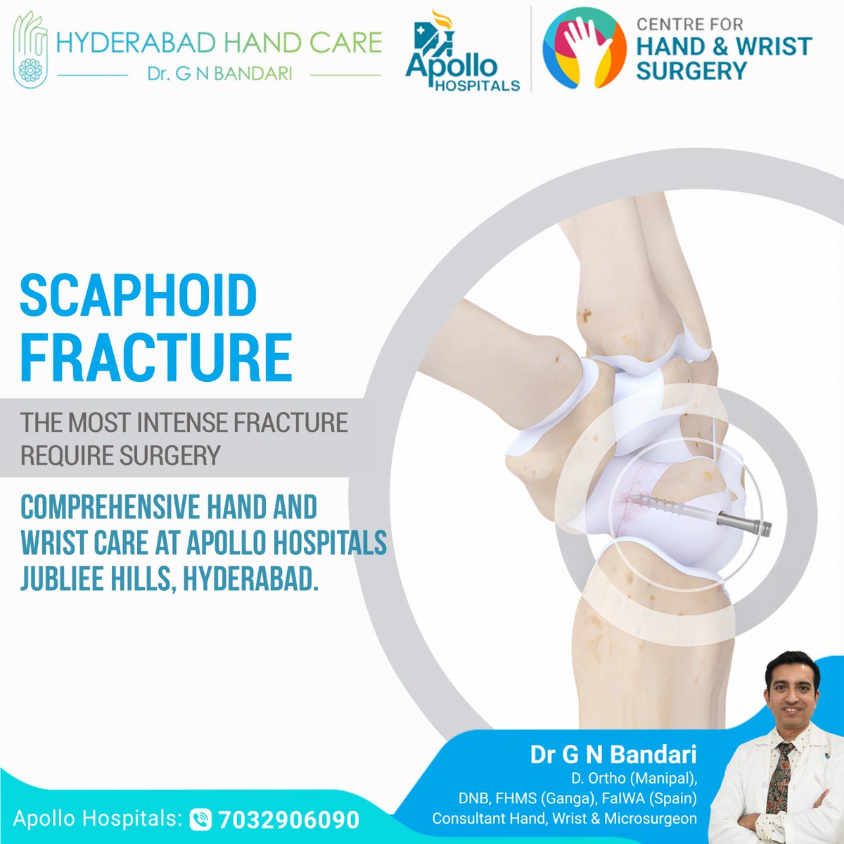 Scaphoid fracture?
#Surgery is key for the most intensive cases. Trust expert care for recovery. Comprehensive Hand and Wrist care at #ApolloHospitals, #JubileeHills, #Hyderabad. Let us help you find relief.

For more visit :  
 hyderabadhandcare.com