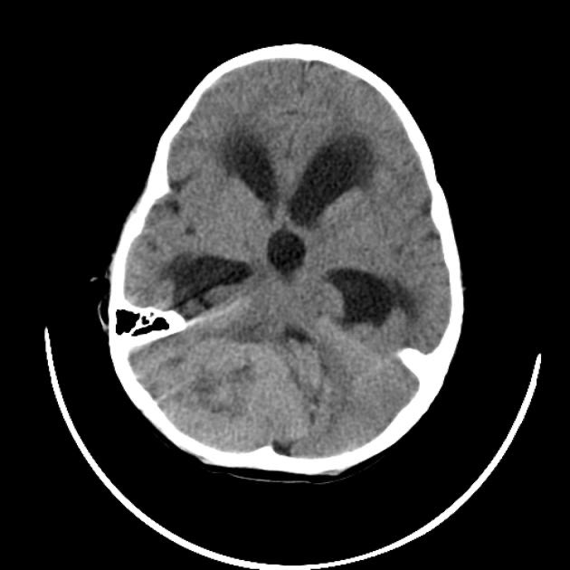 อีกเคสมาด้วย psychomotor retard. ตอบสนองช้าๆ ซึมๆ ไม่กินข้าว ~1เดือน ประวัติปวดหัวอะไรไม่ชัดเจน บอกว่าเคยเป็นมะเร็งเต้านมรักษาหายแล้วประมาณสองปี สรุป CT brain เป็นงี้เลย (รูปจากเน็ต) metastasis Rt cerebellum + obstructive hydrocephalus โพรงน้ำบานมากๆ ถึงว่า frontosubcortical พัง