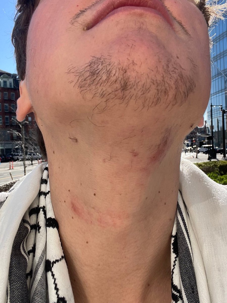 "None of the arrested protesters reported any injuries" -<a href="/masslivenews/">masslivenews</a> 

From the students arrested at Emerson:

"I was choked out, someone in my van had a visibly broken nose"

"they threw me chin first into concrete"

"There were students who were DRAGGED along the concrete"