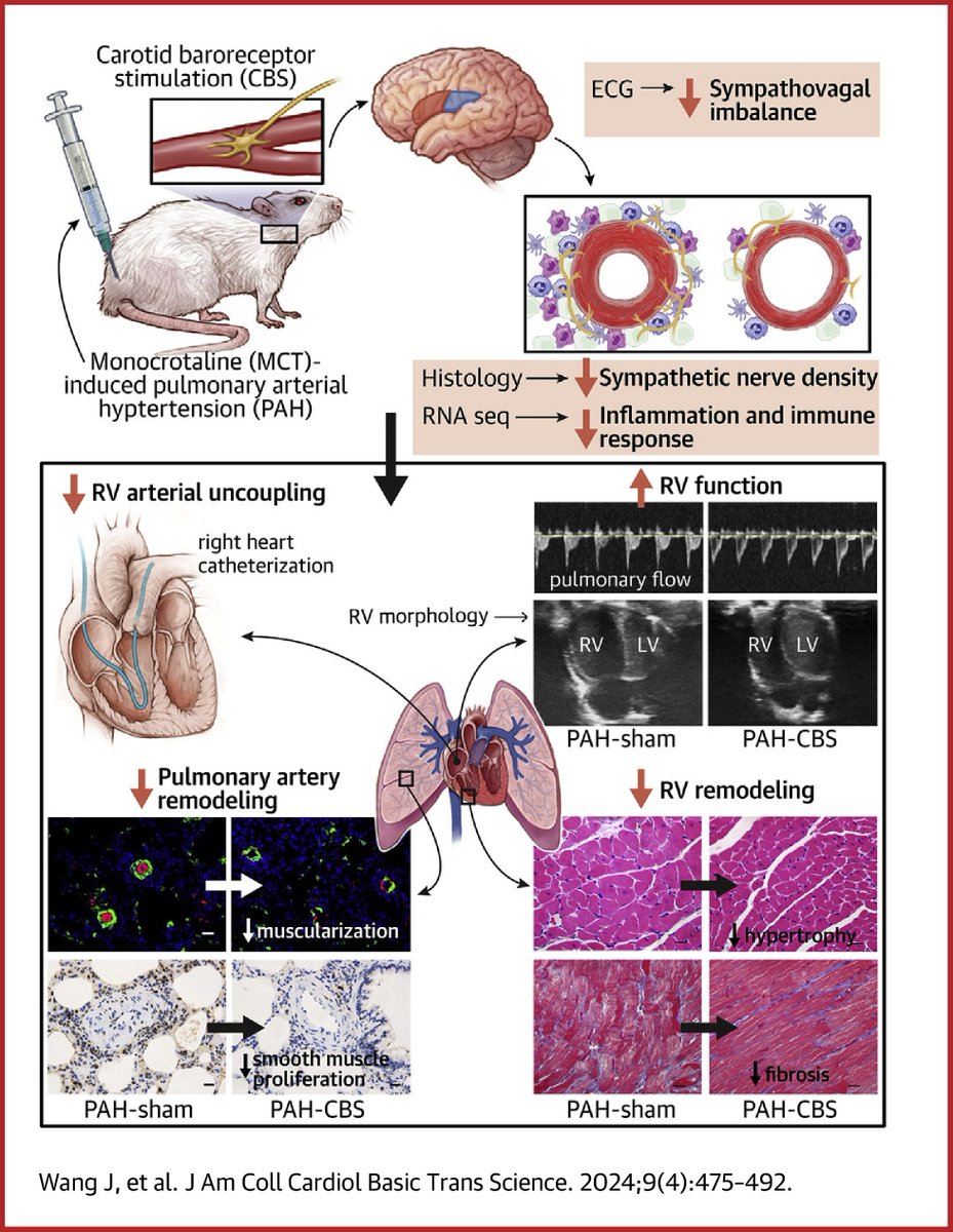 Dysfunction of the autonomic nervous system is linked with PAH. In this #JACCBTS article, authors demonstrate improvement in PA remodeling and RV dysfunction with carotid baroreceptor stimulation in rats. bit.ly/3QiHN0O

(1/2) #cvPAH #BasicScience #TranslationalResearch