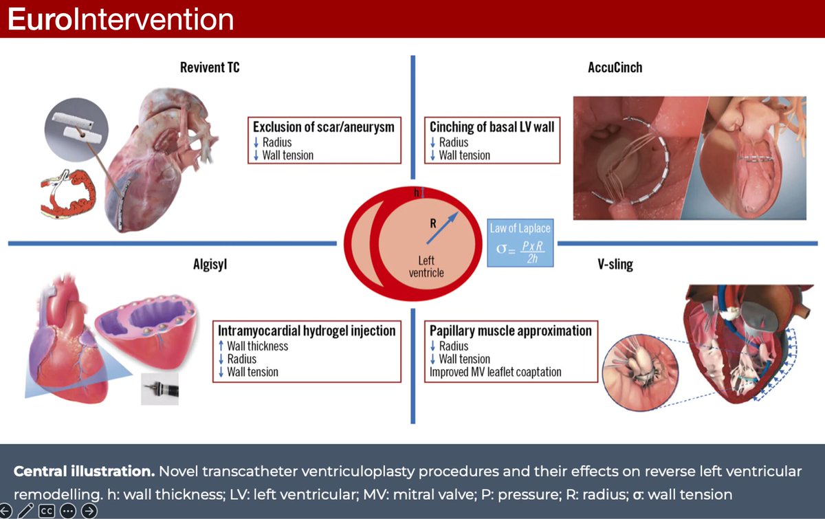 This Expert Review: ✅Addresses the rationale for left ventriculoplasty. ✅Presents previous surgical and percutaneous attempts in the field. ✅Provides an overview of novel transcatheter left ventriculoplasty devices and their respective trials. ✅Highlights potential challenges