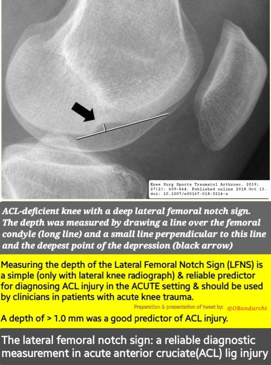 Measuring depth of Lateral Femoral Notch Sign (LFNS) by Lat Knee Radiograph is reliable predictor for Dx of ACL injury in ACUTE setting & can be used by clinicians in patients with acute knee trauma. ♦️A depth of > 1.0 mm : a good predictor of ACL injury) doi.org/10.1007%2Fs001…