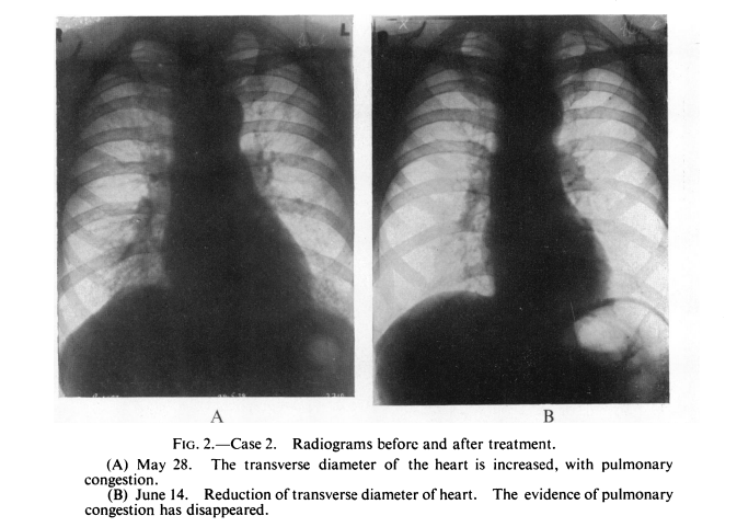 Enlarged heart before and after thiamine treatment (B1), big difference after a short time (1940) always though that exercise induced enlarged heart was ,partly, due to (exercise-induced) thiamine deficiency