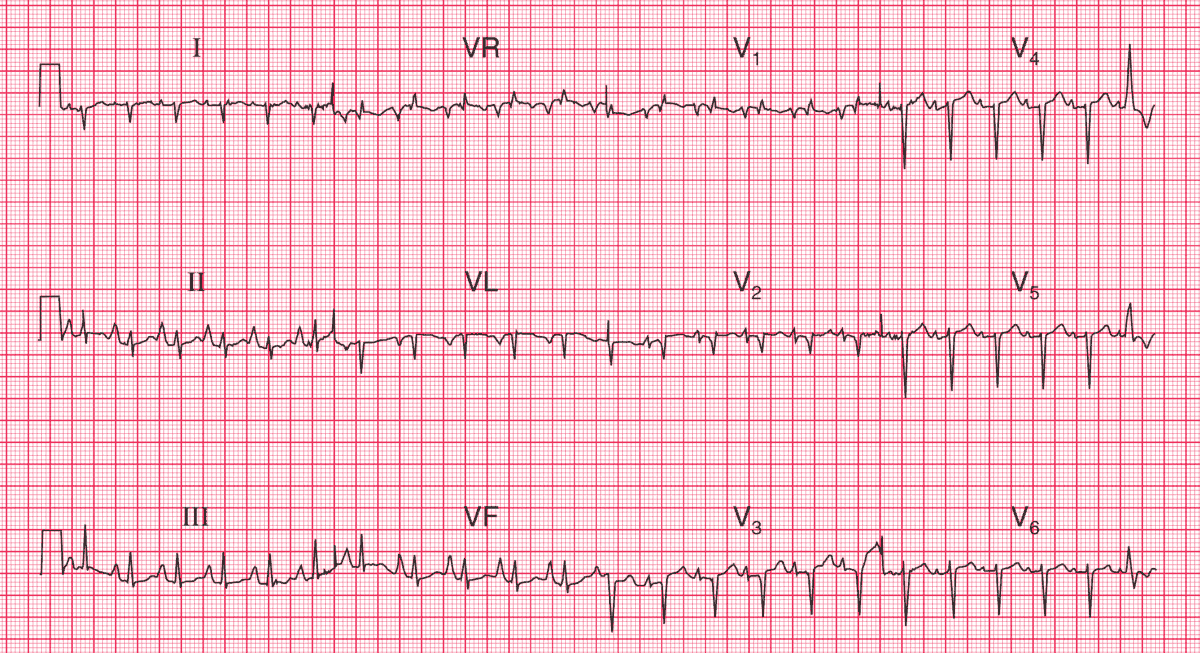 A 60 y/o man with severe breathlessness, which had developed over several years. His jugular venous pressure is raised.
- What do you see on his ECG ?

➡️ Interpretation and Answer: manualofmedicine.com/ecgs/ecg-case-…

#medtwitter #foamed #cardioed #CardioTwitter