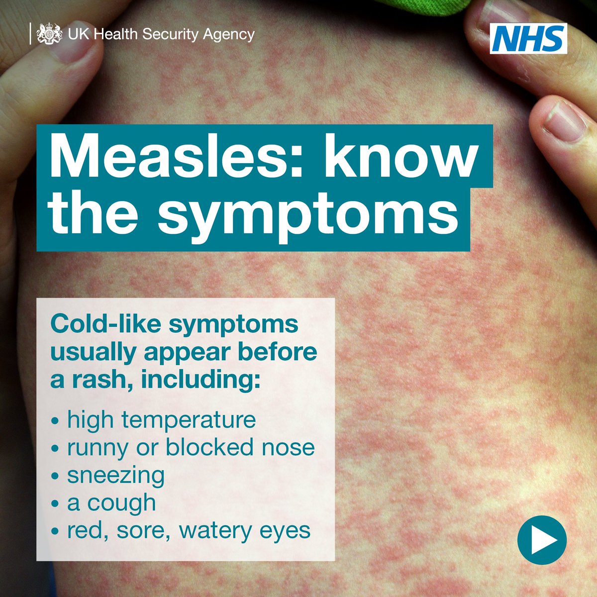 Here’s what you need to know about #measles, from the signs and symptoms to look for to what to do if you think you or your child has measles. More info: nhs.uk/conditions/mea…