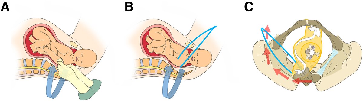 AJOG Expert Review in Labor: A critical evaluation of the external and internal maneuvers for resolution of shoulder dystocia - Posterior axillary traction ow.ly/szz250RmYER @ACOG #obgyn