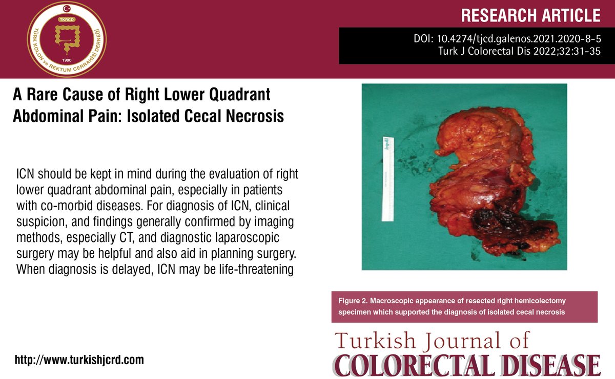 turkdiscolrect's tweet photo. A Rare Cause of Right Lower Quadrant Abdominal Pain: Isolated Cecal Necrosis

You can see the free full text of the research by Semra Demirli Atıcı et al.

Link : https://t.co/XqBn49KLdY

#Acuteabdomen #acuteappendicitis #cecalnecrosis #msenteriicischemia #tocilizumab https://t.co/NYWs15fi6c