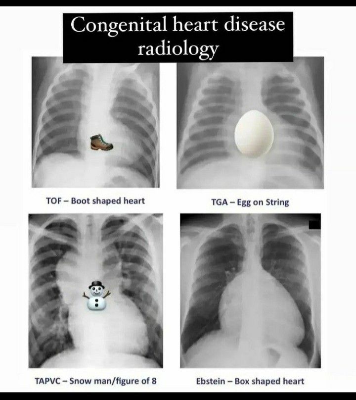 Chest radiograph features of some congenital heart diseases.