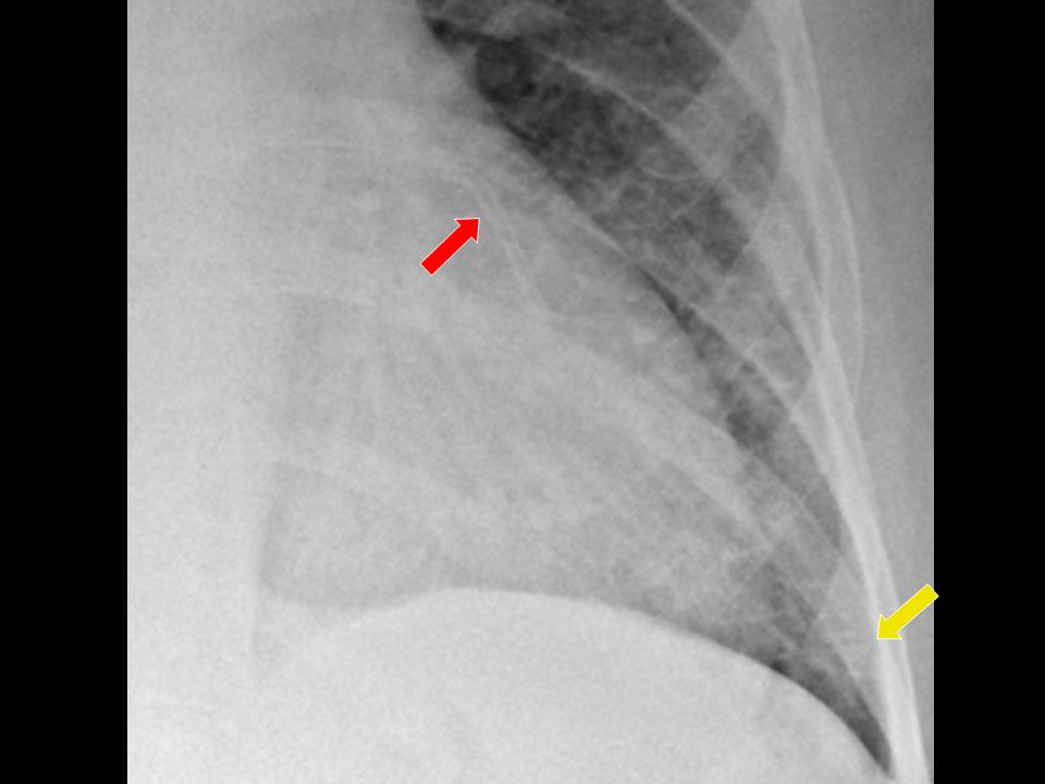 Check your answer to this week's radiology image challenge below! The answer is a) Cardiogenic pulmonary oedema. Find a more detailed explanation on the ERS Facebook: facebook.com/EuropeanRespir… More case studies are available on the ERS Respiratory Channel: channel.ersnet.org/channel-52-rad…