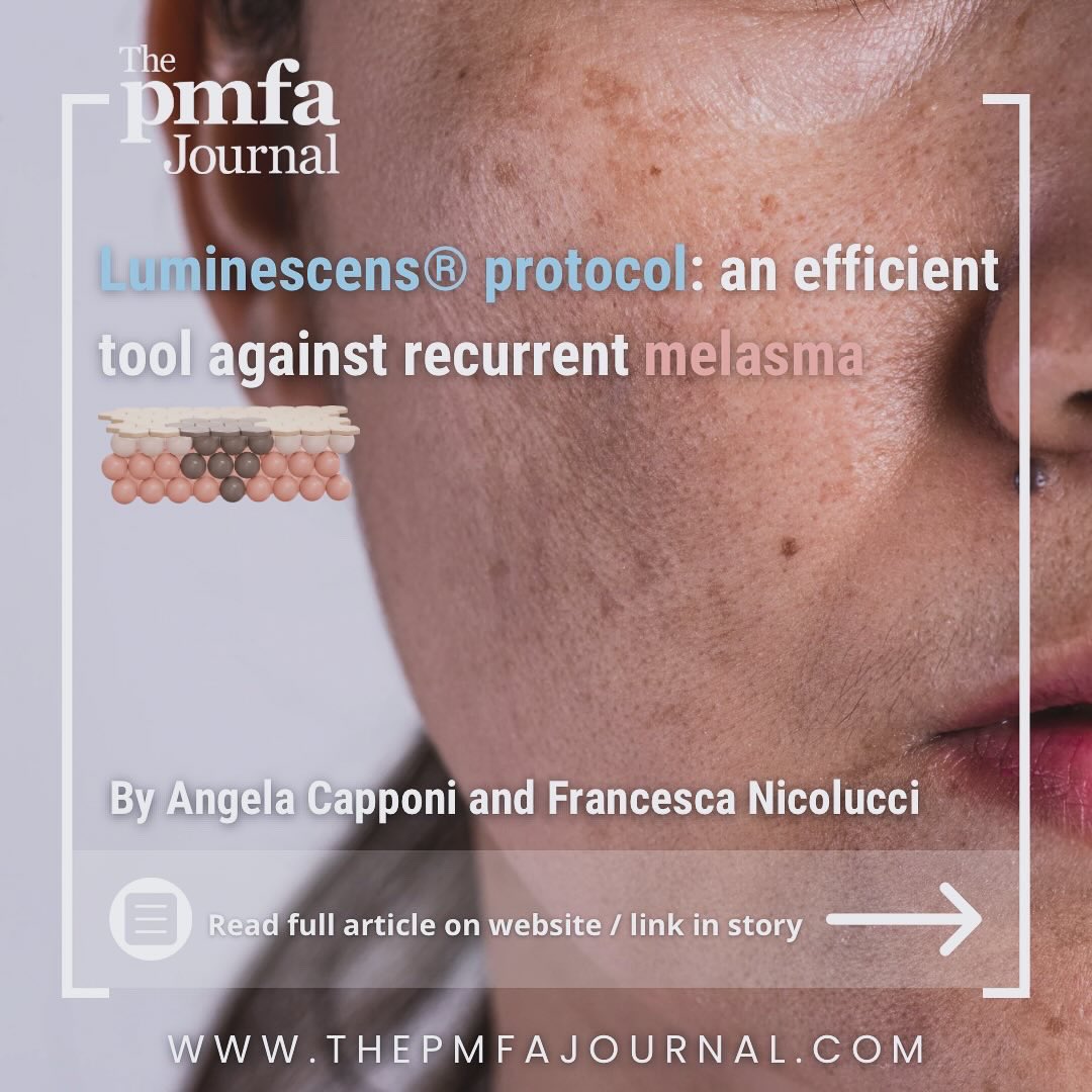 Struggling with inconsistent results and constant relapses from #melasma treatments? Discover how the Luminescens® protocol offers a safe and effective solution.   📚Read full article: thepmfajournal.com/education/case…