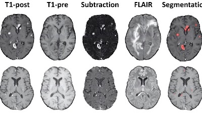 UCSF-BMSR MRI Dataset includes 412 patients with 560 multimodal brain MRIs with expert annotations of 5136 brain metastases doi.org/10.1148/ryai.2… @RadRudie @UCSFimaging @UCSDImaging #cancer #AI #ML