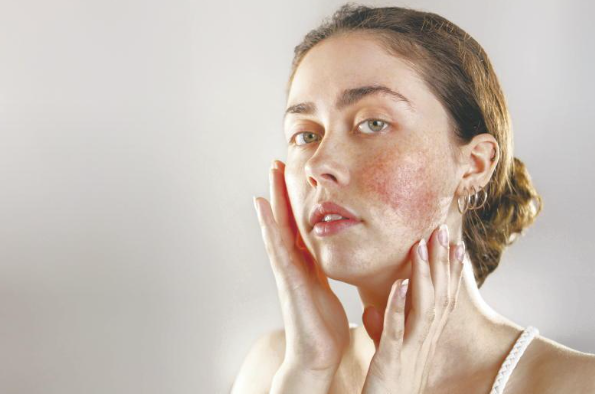 Great advice on how to manage the skin condition rosacea from our Consultant Dermatologist Prof Anne-Marie Tobin in today's farmers journal. Well worth a read ...bit.ly/4b8tF23