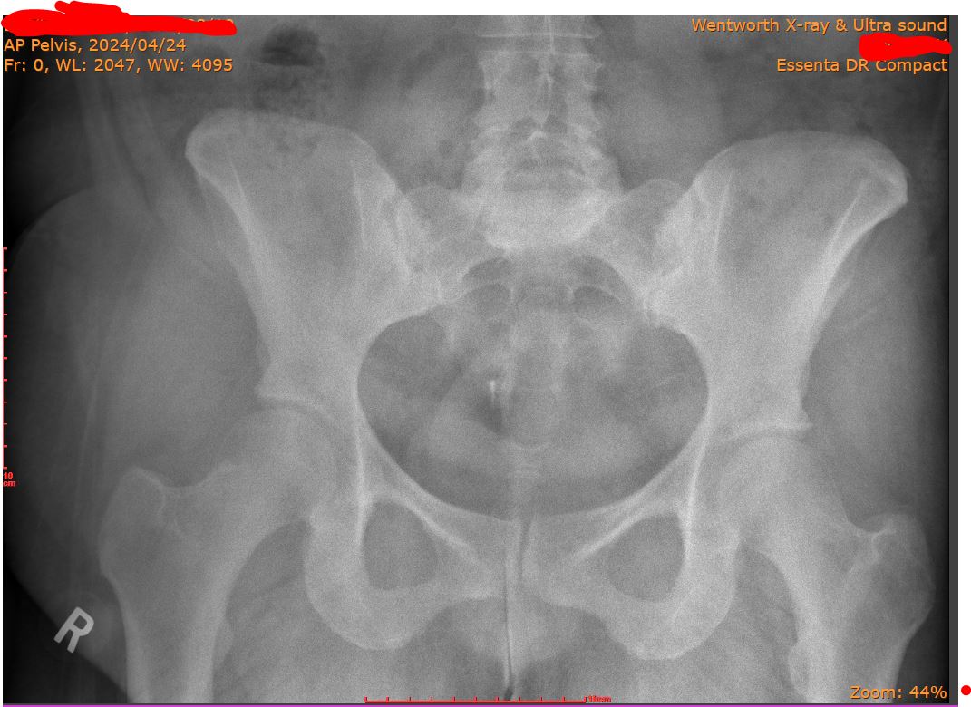 Any radiologists or Dr's out there that can help? Right hip pain, CPR is 14 but Rheumatoid factor is normal. ANA still pending. #Radiology #ineedaDR #hippain #ouch