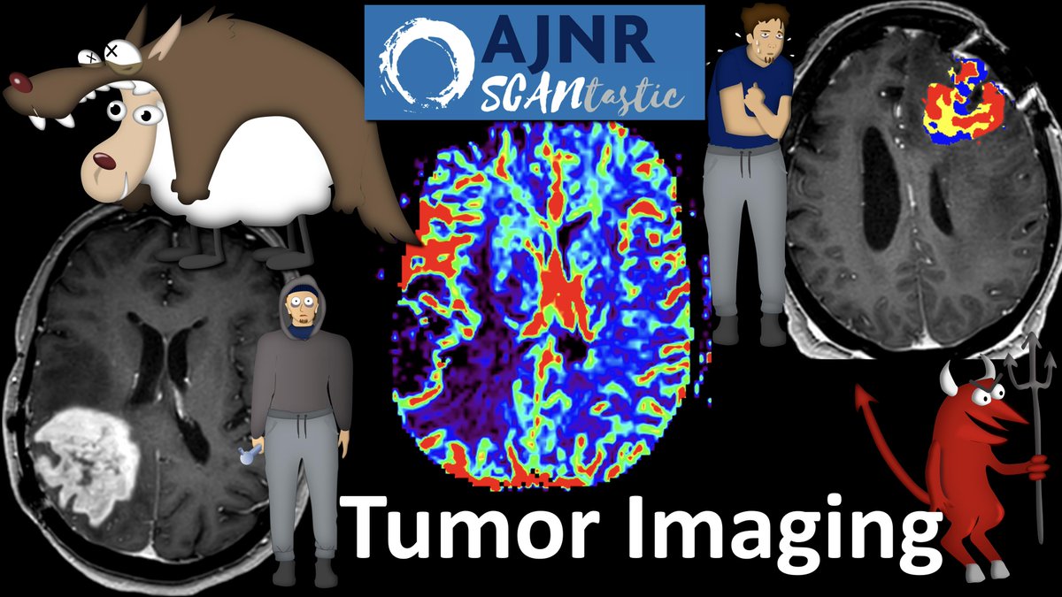 1/Have some confusion about tumor perfusion? Do you go into a coma looking at scans for glioma? Never fear! Read on for this month's @theAJNR SCANtastic for what you need to know on the latest in brain tumor imaging! ajnr.org/content/45/4/4…