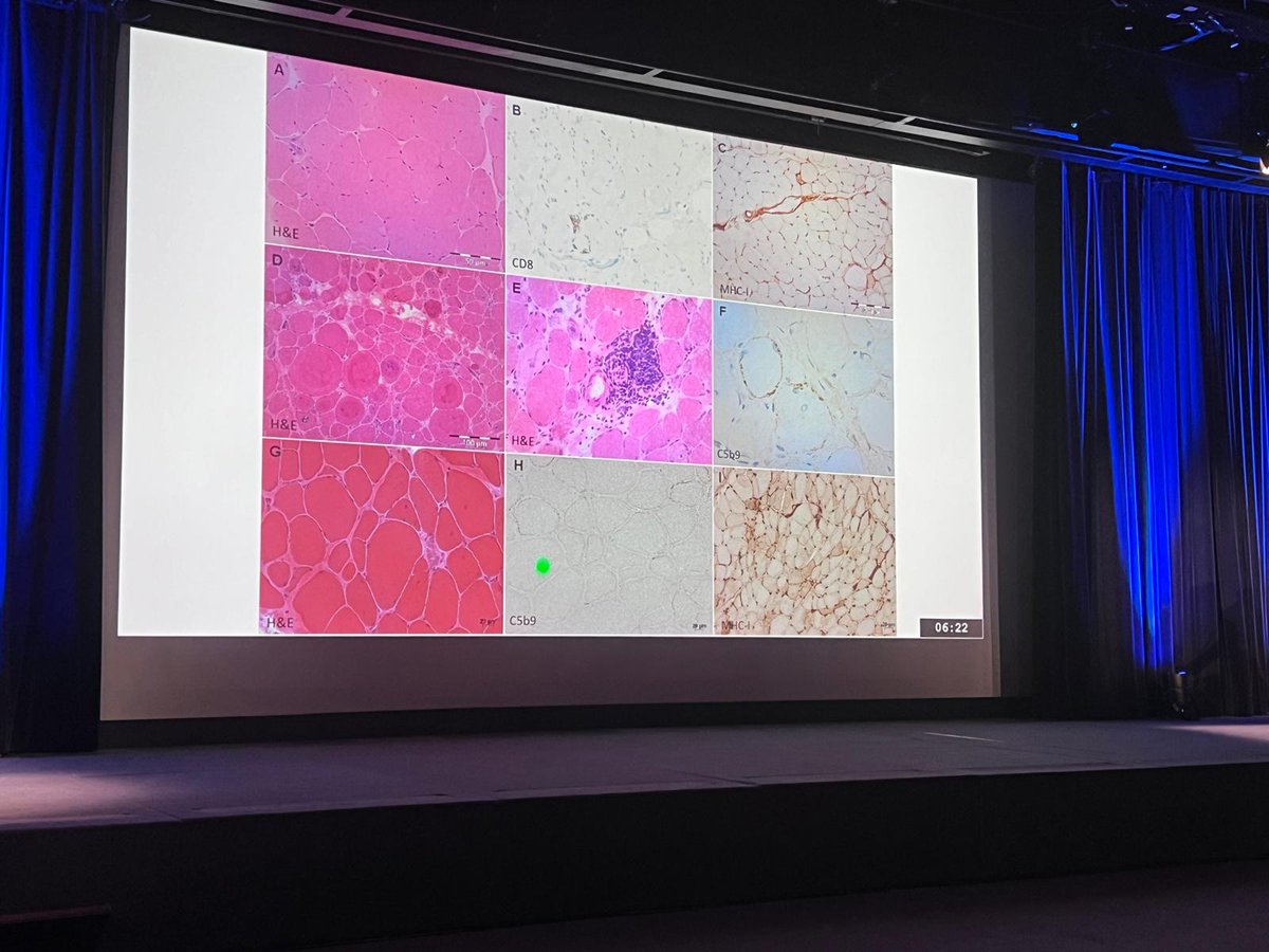 👩🏻‍🔬🔬 Oh là là! Check out the presentation of Dr Laura Llansó in the #Miology2024 meeting in Paris🇫🇷, on anti-HMG-CoA reductase necrotizing myopathy in statin- naive very young patients and the association with HLA-DRB1*11:01, in the absence of gene mutations.

👇🏿👇🏿