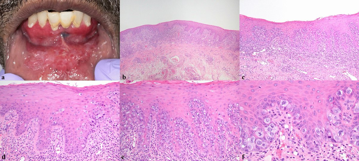 Paget disease of the oral mucosa? Who knew? Our friends in Cleveland did! Check it out in @HeadNeckPathol #OpenAccess link.springer.com/article/10.100… #ENTPath #OralPath @MeladDababnehMD @ENT_Path @CCFPathRes @CleClinicMD @HandNPath