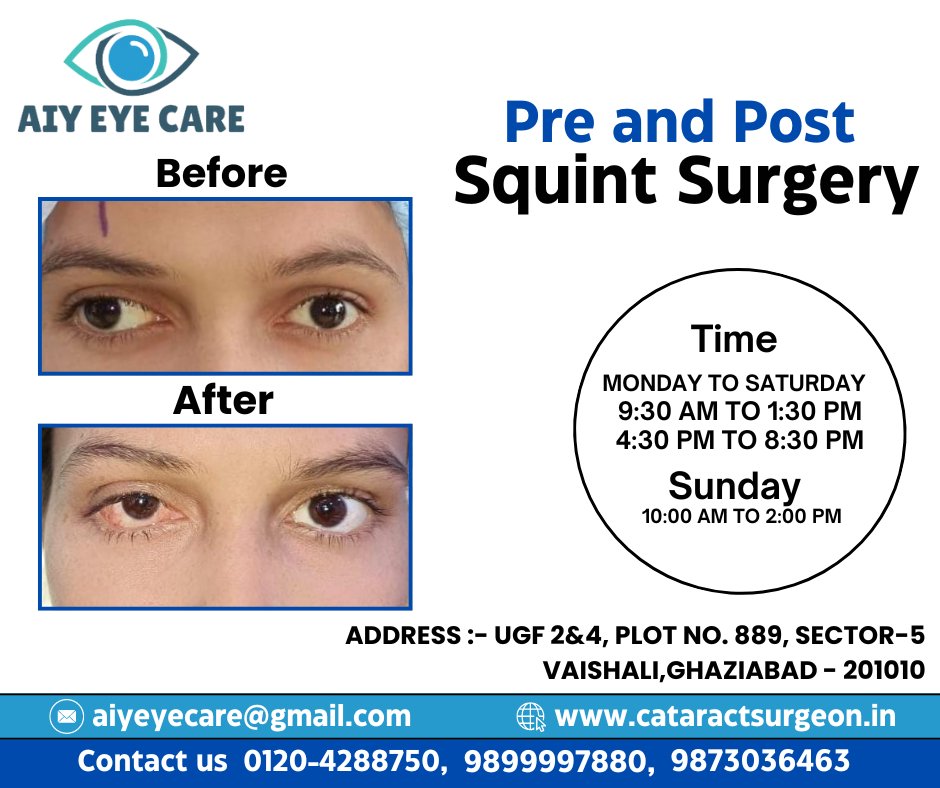 Right eye Squint before operation, Same patient after squint operation.
.
.
.
Call/9899997880 | 9873036463
Website :- cataractsurgeon.in
.
.
.
#aiyeyecare #eyecare #squintsurgery #eyesurgeon #surgeon #EyeDrops #cataractsurgery #cataracttreatment #trending