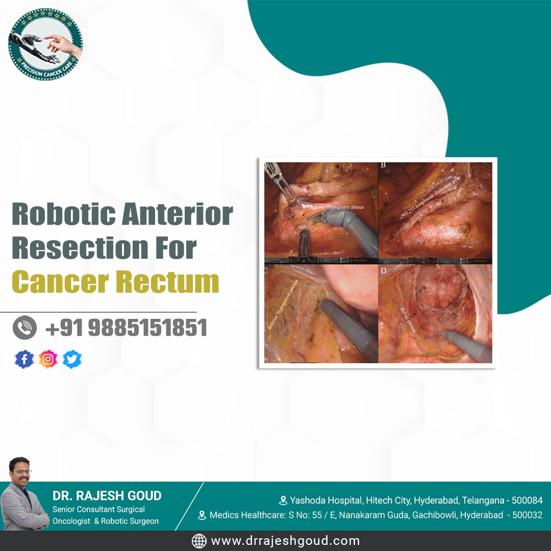 Revolutionize cancer care with our #RoboticAnteriorResection for #RectalCancer: precise, minimally invasive, and transformative surgery for patients.

For more visit:
drrajeshgoud.com