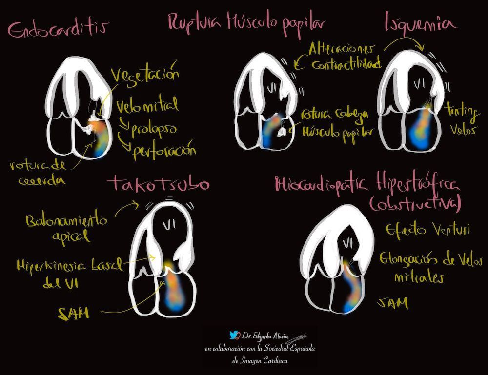 Insuficiencia mitral aguda 📊 buff.ly/3vYC9Kh ◀️ Infografía número 39 de las publicada por Edgardo Alania @Ed_Alania