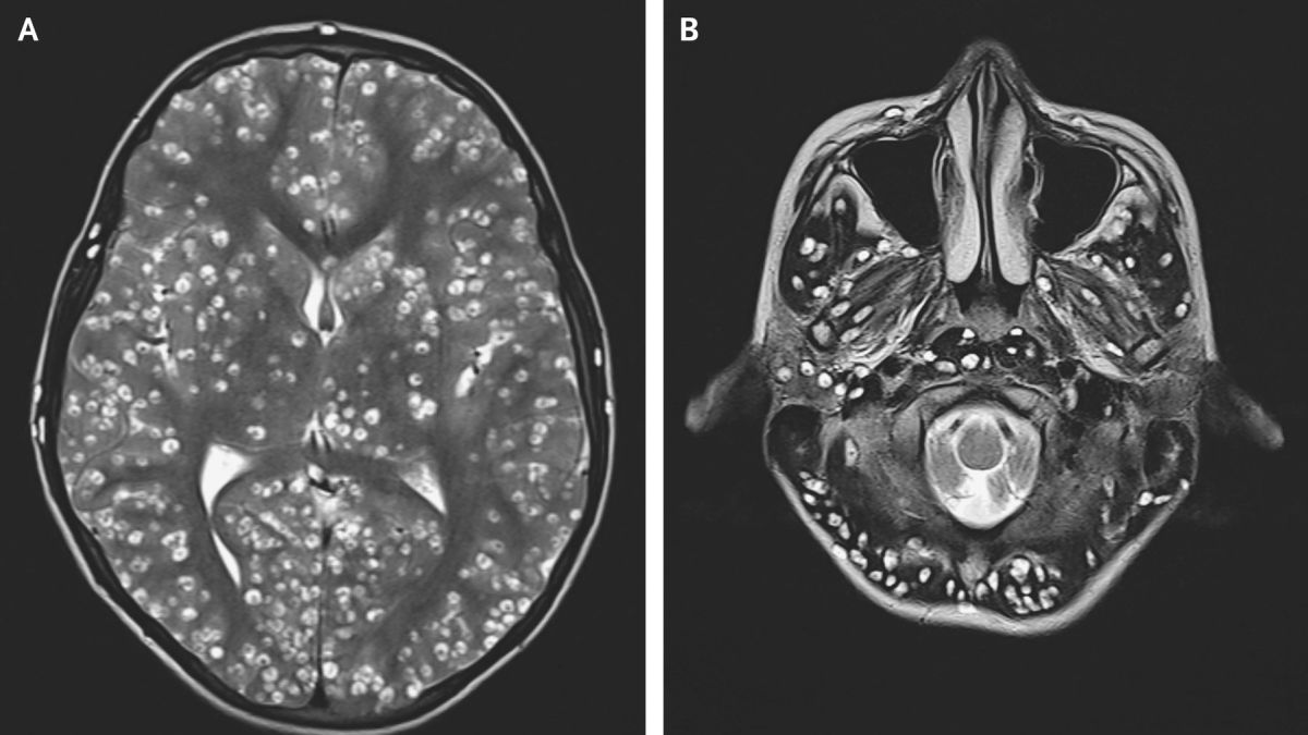 Nicotine is known to eliminate parasites and can cross the blood-brain barrier, ranking it among the most effective treatments for brain parasites. By eradicating these parasites, it reduces brain inflammation, thus clearing brain fog and establishing its status as a nootropic.