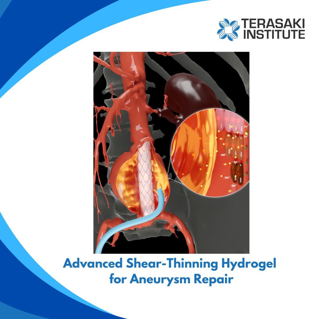 Scientists at the Terasaki Institute have developed a novel, injectable shear-thinning hydrogel for treating abdominal aortic aneurysms (AAA), seals off blood flow effectively but halts aneurysm growth. buff.ly/44hWcA7 #TerasakiInstitute #Hydrogels #Aneurysms