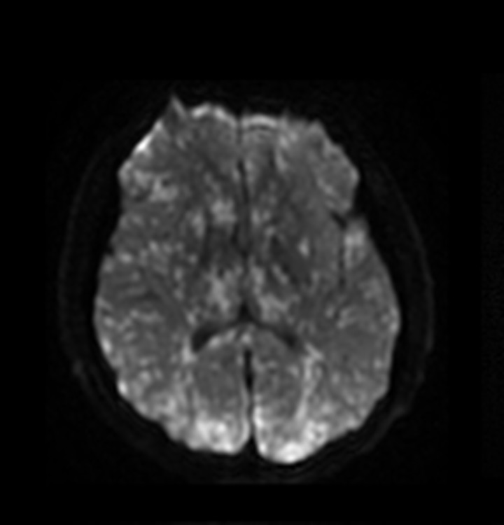 #AJNRcow >> April 25, 2024 >> A 26-year-old man presents at a Level 1 trauma center after being hit by a vehicle traveling at 30 mph (48 km/h). Initial Glasgow Coma Score (GCS) score was 14 and trauma CT survey showed only mild intra-abdominal injuries with lower extremity